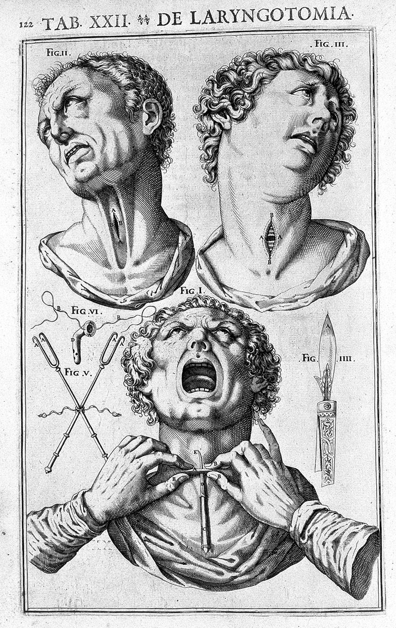 c-Wellcome-Collection_Tracheotomy_from_Casserius,_De_Vocis_Auditusque_Organis